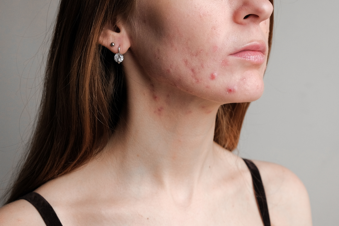 Suzi’s Guide to Caring for Acne-Prone Skin